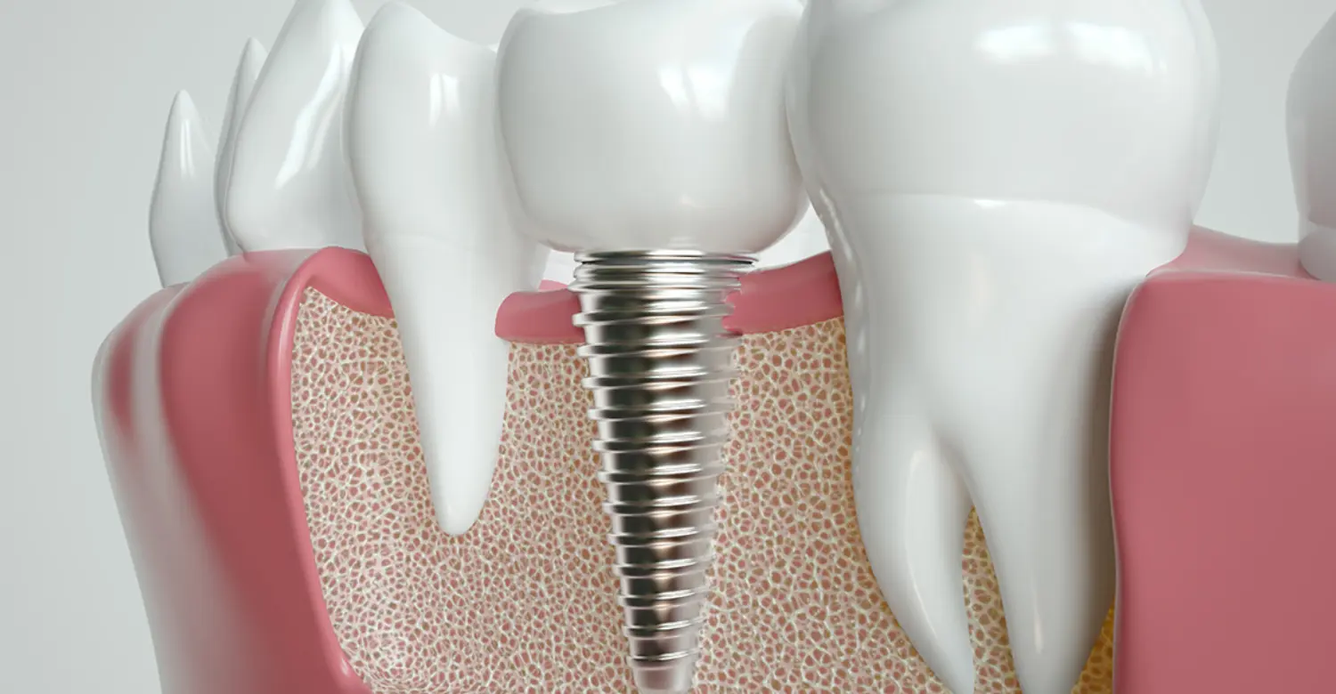 Dental Implants and Osteoporosis 2